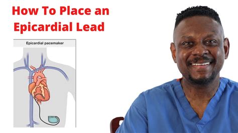 lv lead placement techniques|where are epicardial leads placed.